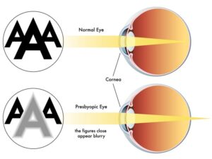 Presbicia: Qué es