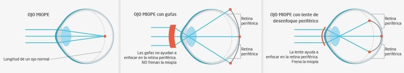Desenfoque periferico en el control de la miopia